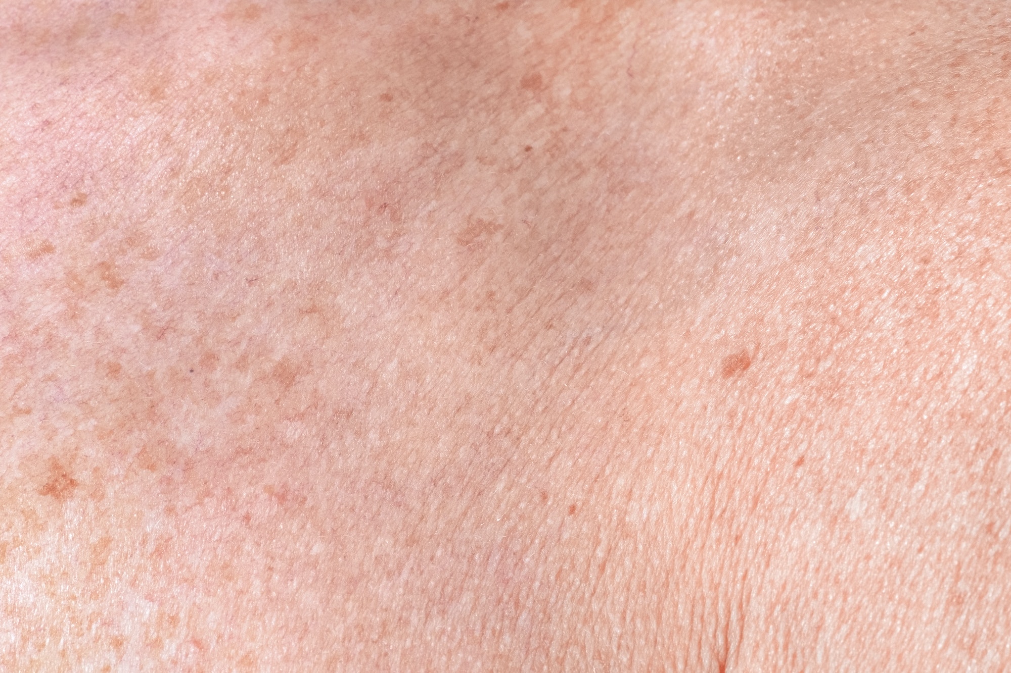 Aging female skin with melasma spots