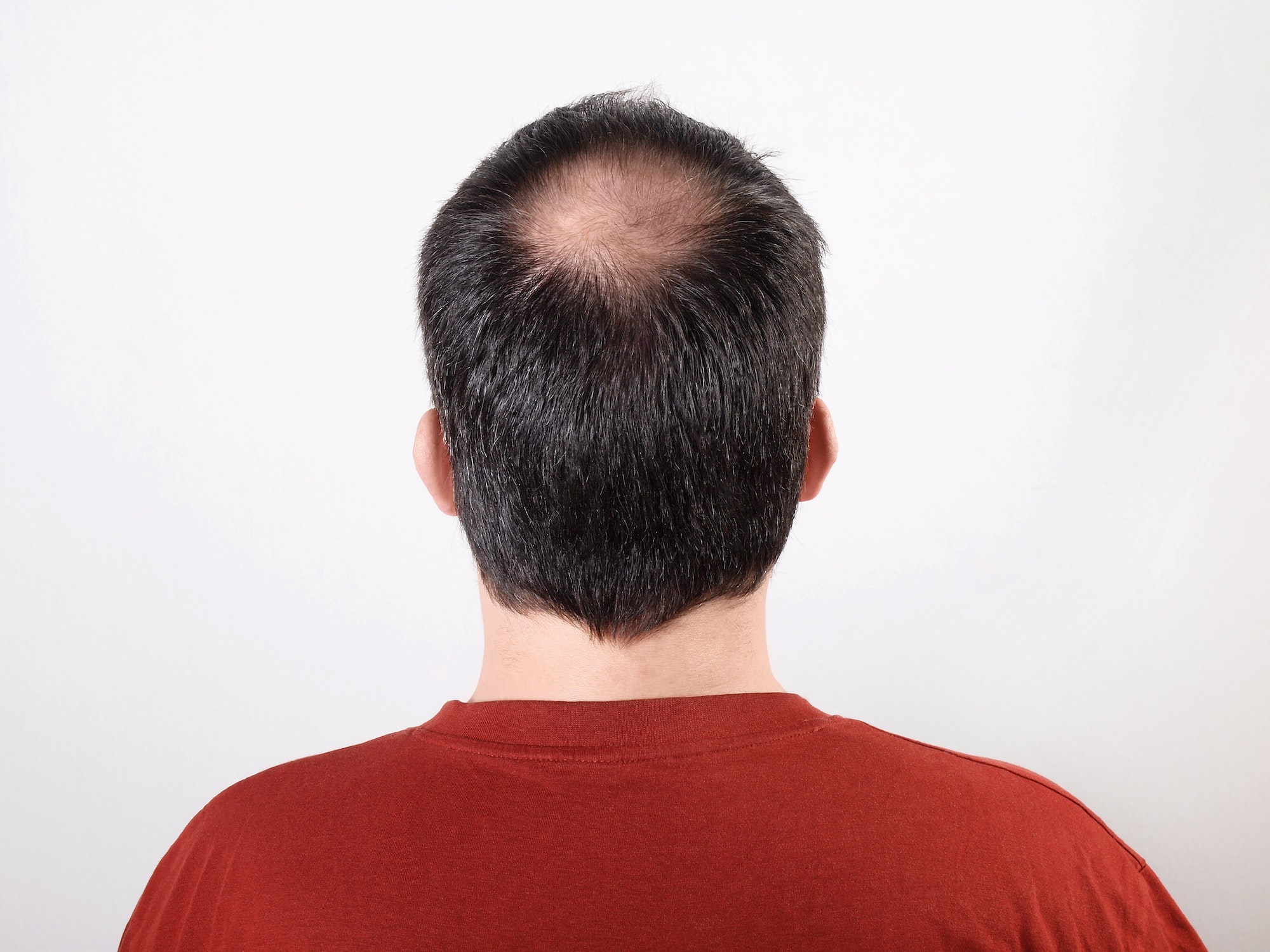back of male head with thinning hair or alopecia or hair loss