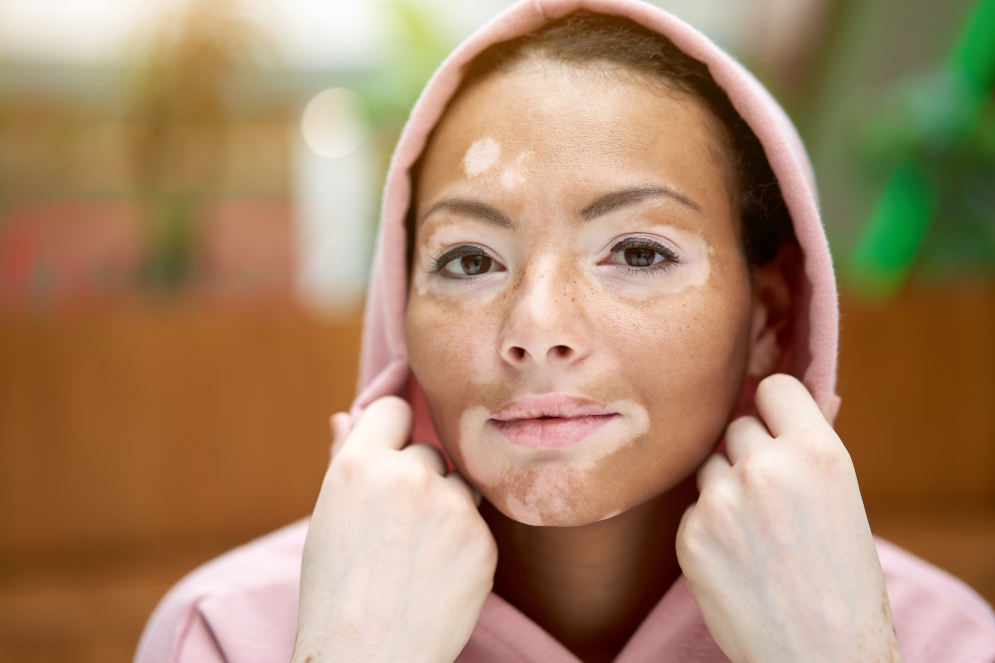 Black African-American woman with vitiligo