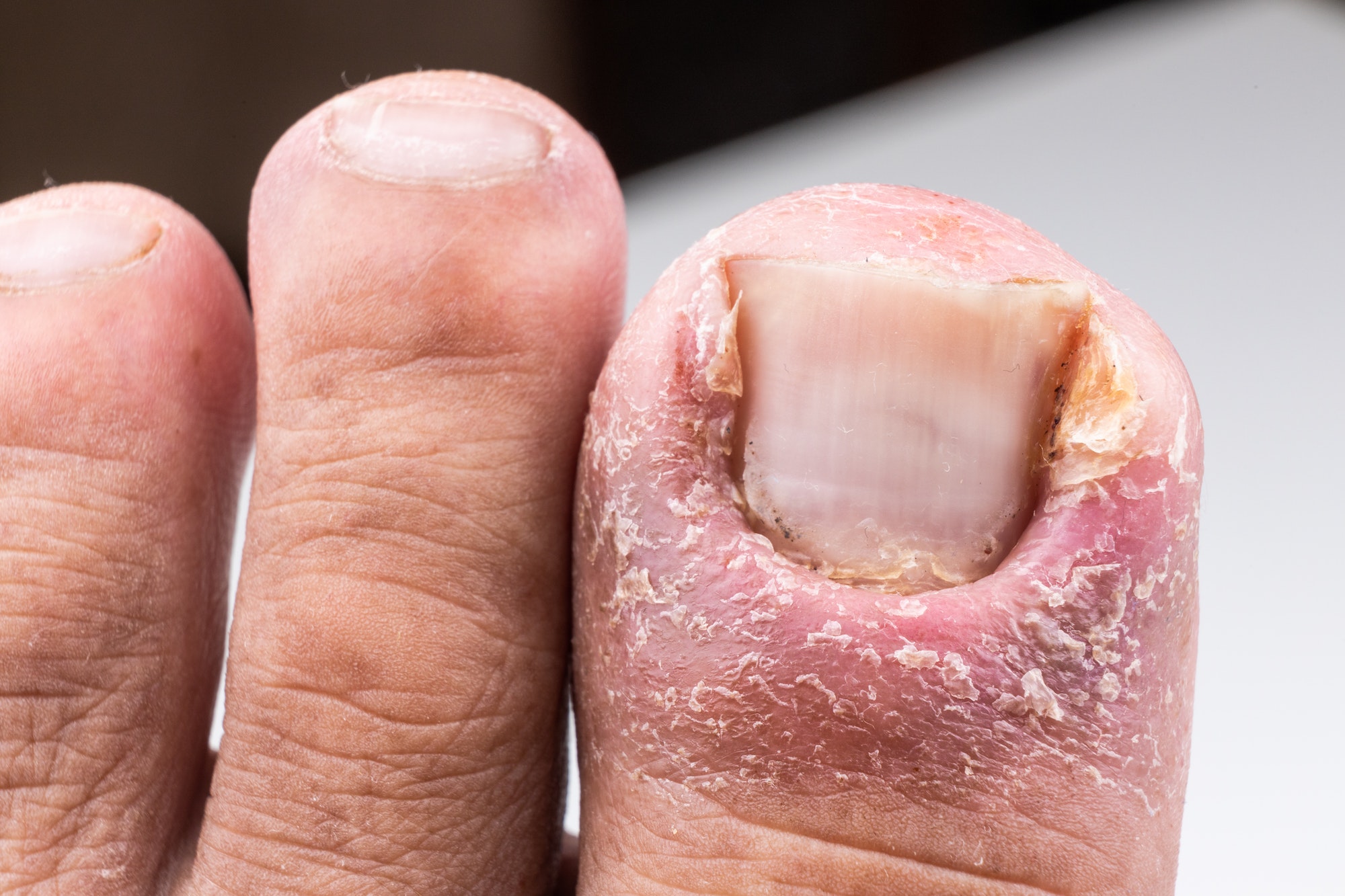 Closeup of painful inflammed infection of the big toe due to ingrown toenail