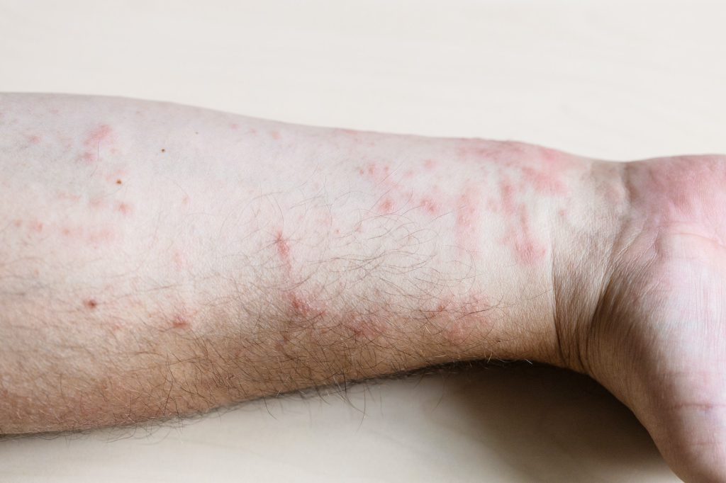 skin inflammation on inner side of forearm